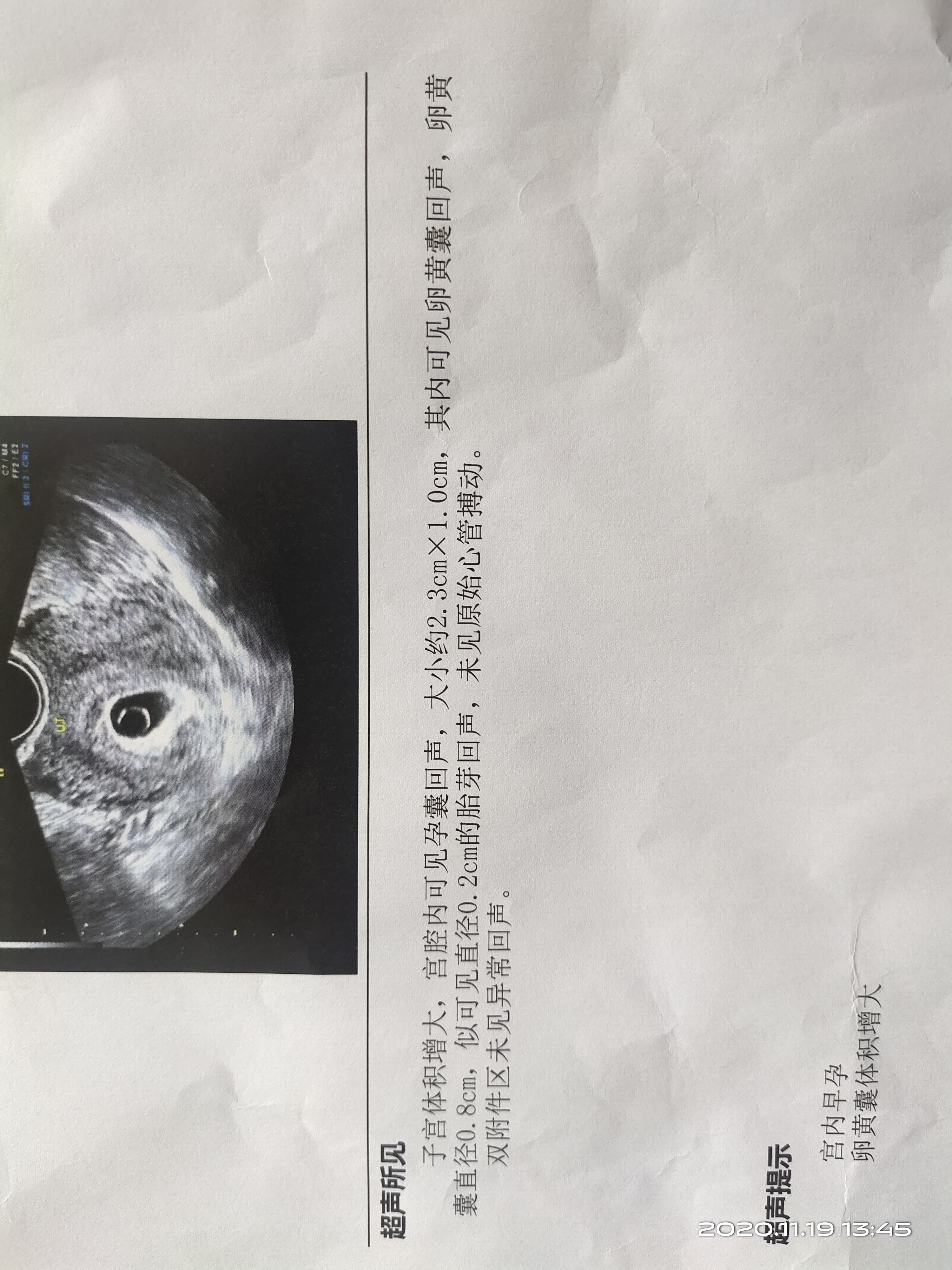 移植后第38天检查结果如图是不是留不住了