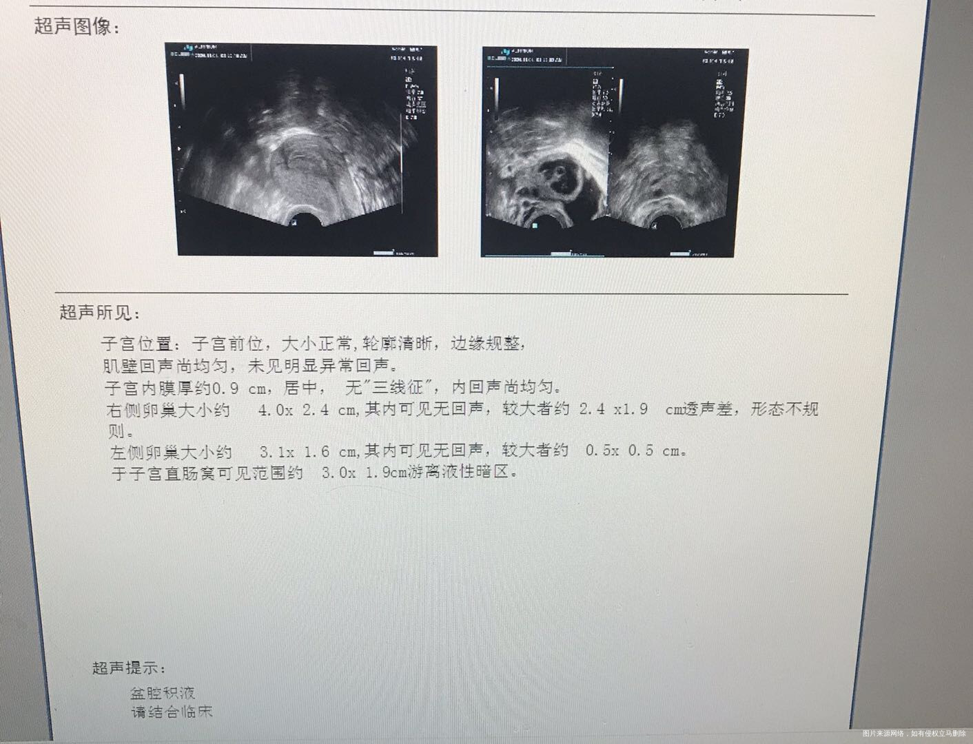 请问我这个排卵了吗10月31号打了10000