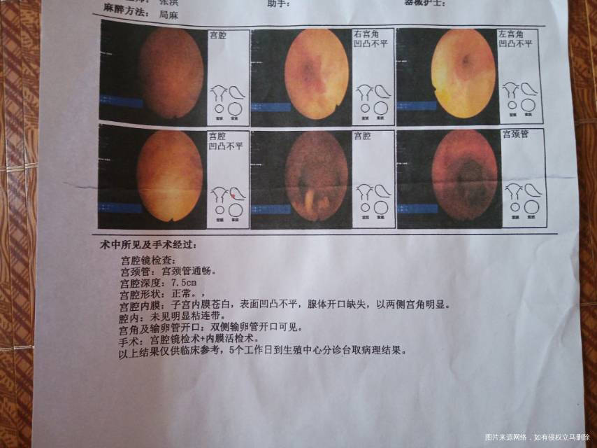 输卵管堵塞做的试管婴儿有子宫息肉做了宫腔镜检
