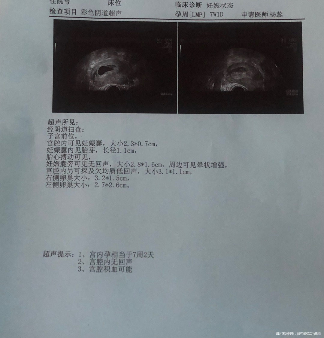 1026移植囊胚一枚移植19天出血就医b超显