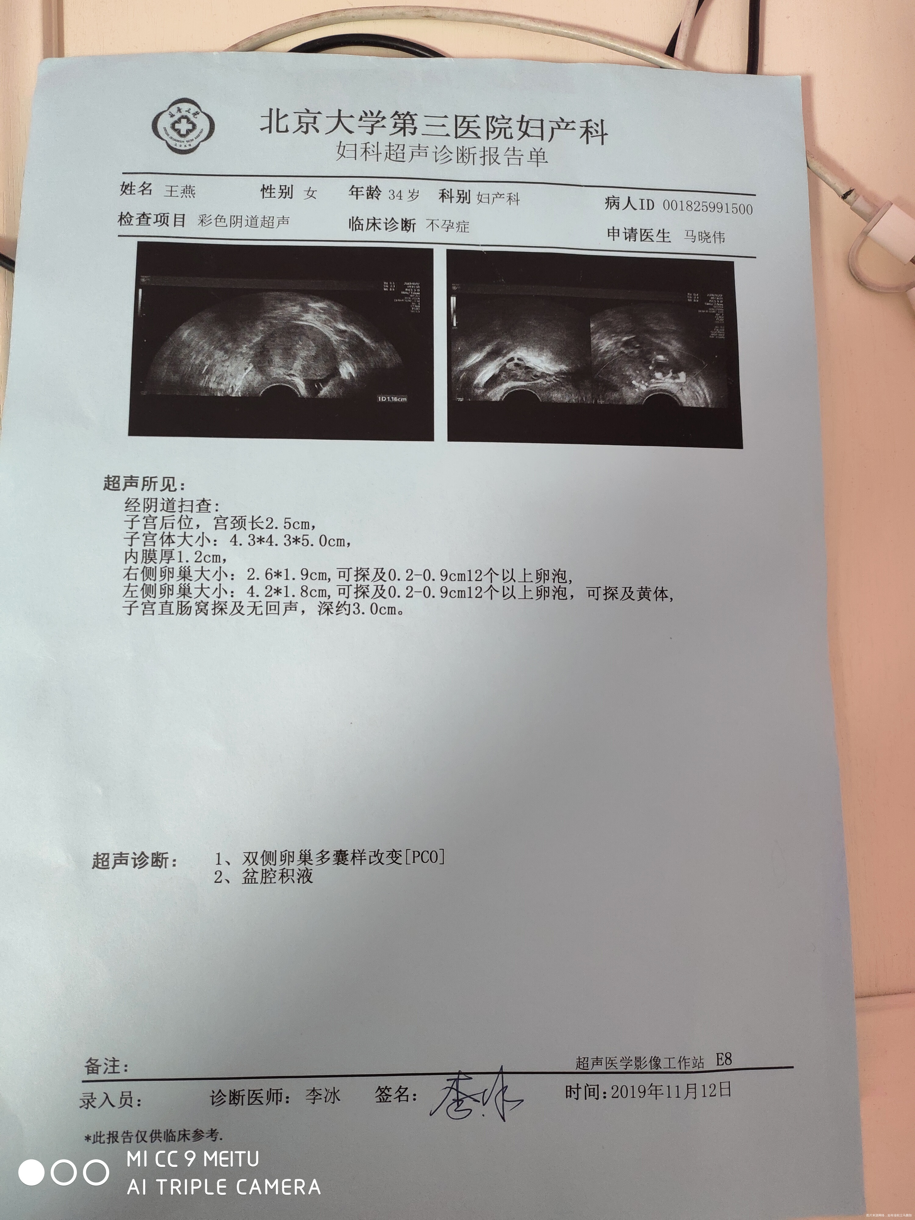 我结婚7年未孕AMH5妇科彩超提示多囊卵巢因