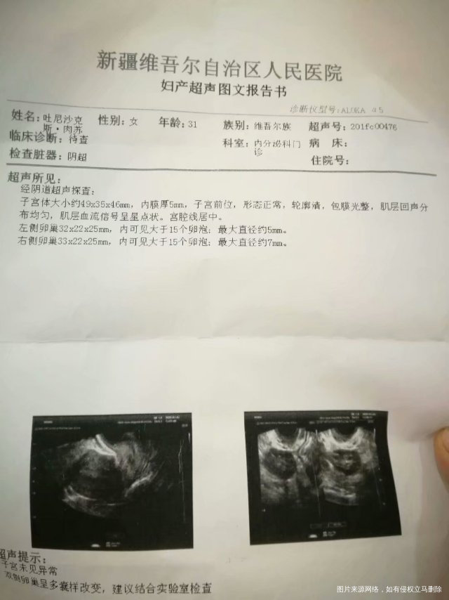 我是今年的元月份被查出来多囊卵巢综合症然后我