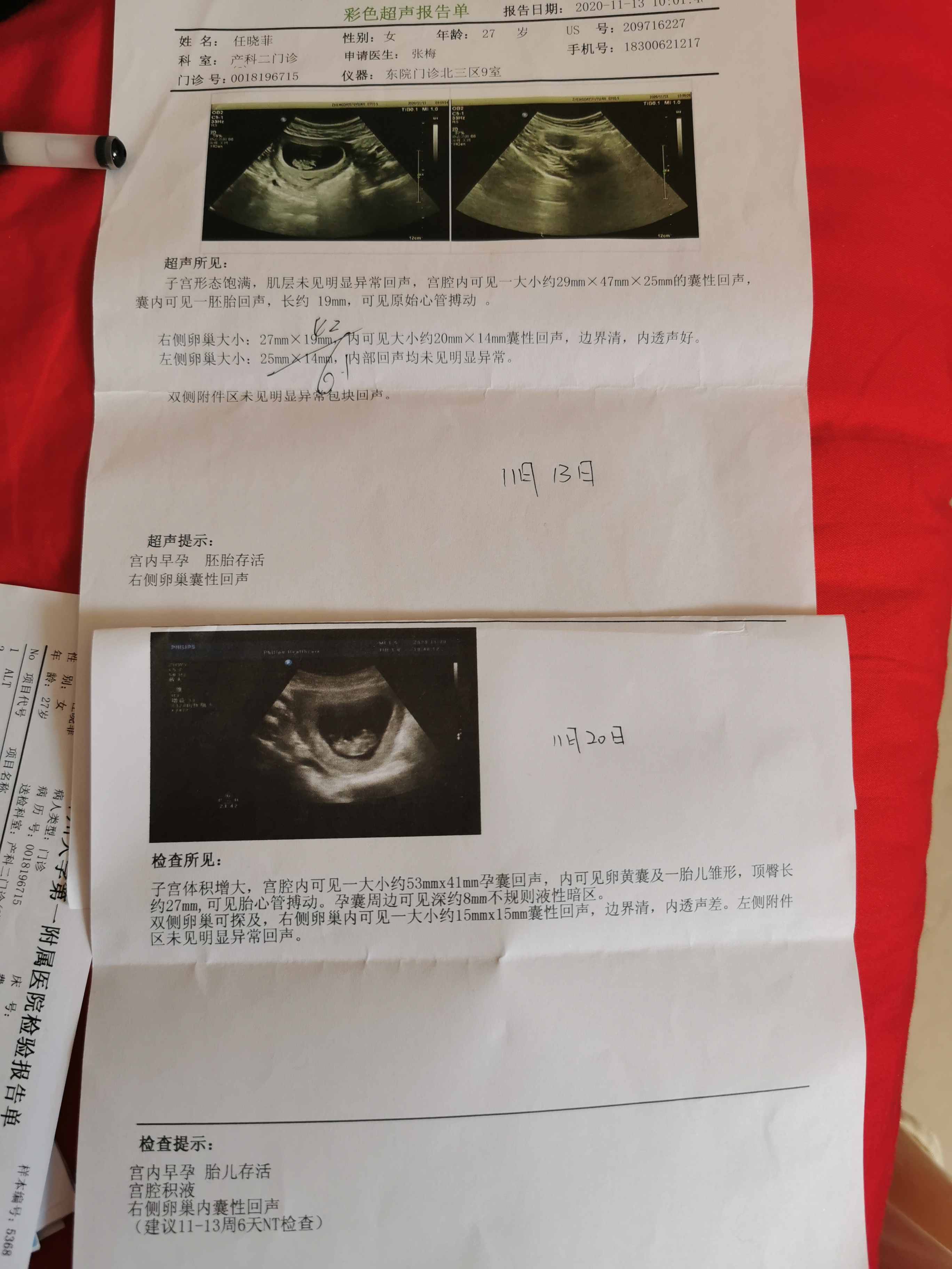 上周做b超有积液很担心这周又去做了b超发现一