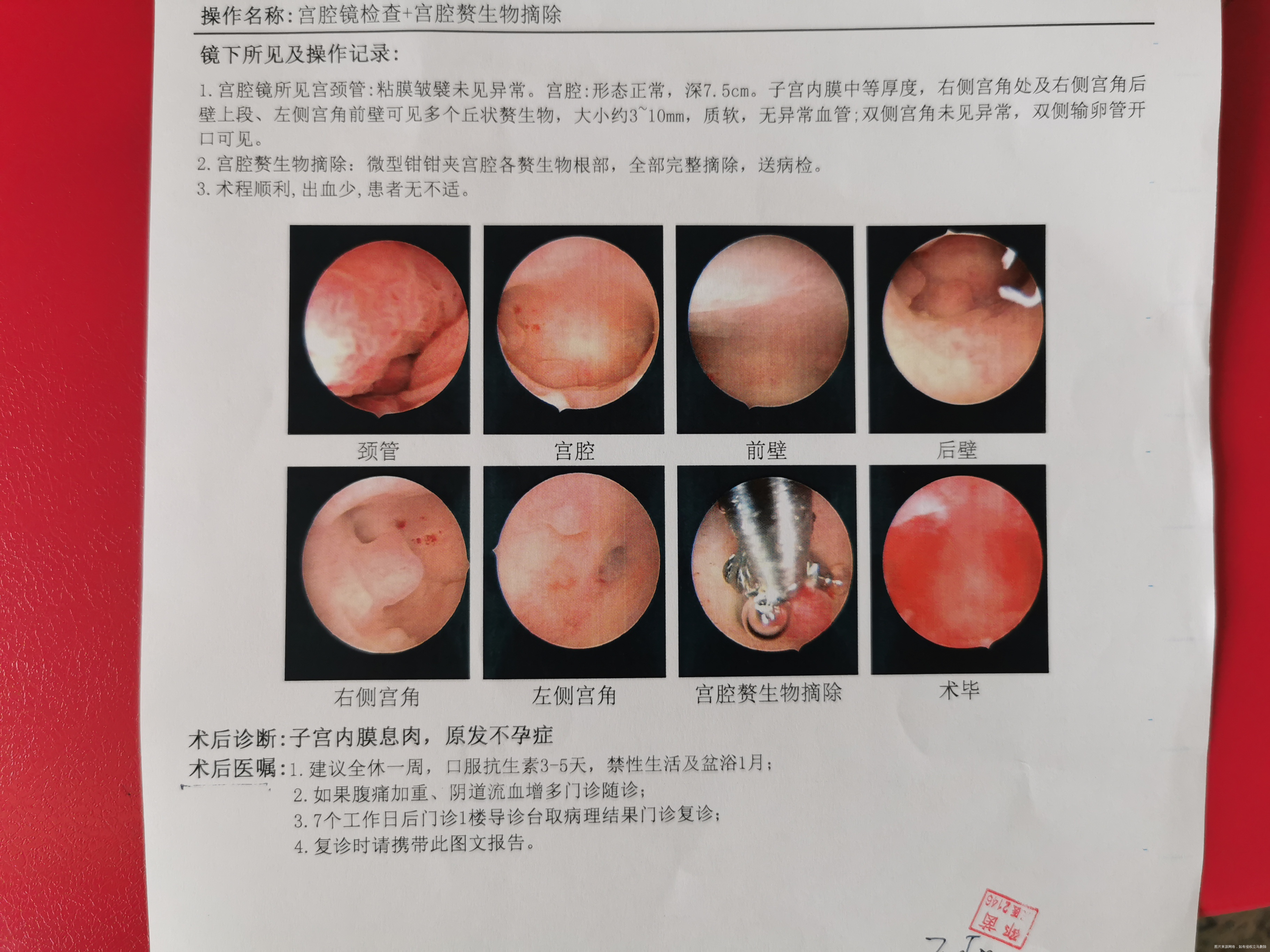 移植前宫腔镜检查出多个赘生物并进行了摘除请问