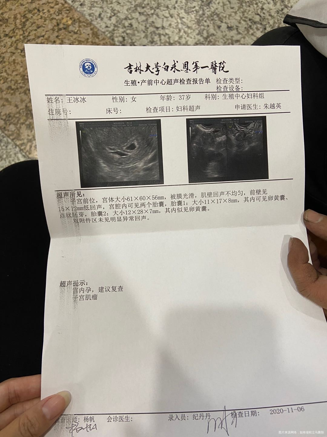 试管移植第25天无胎心胎芽