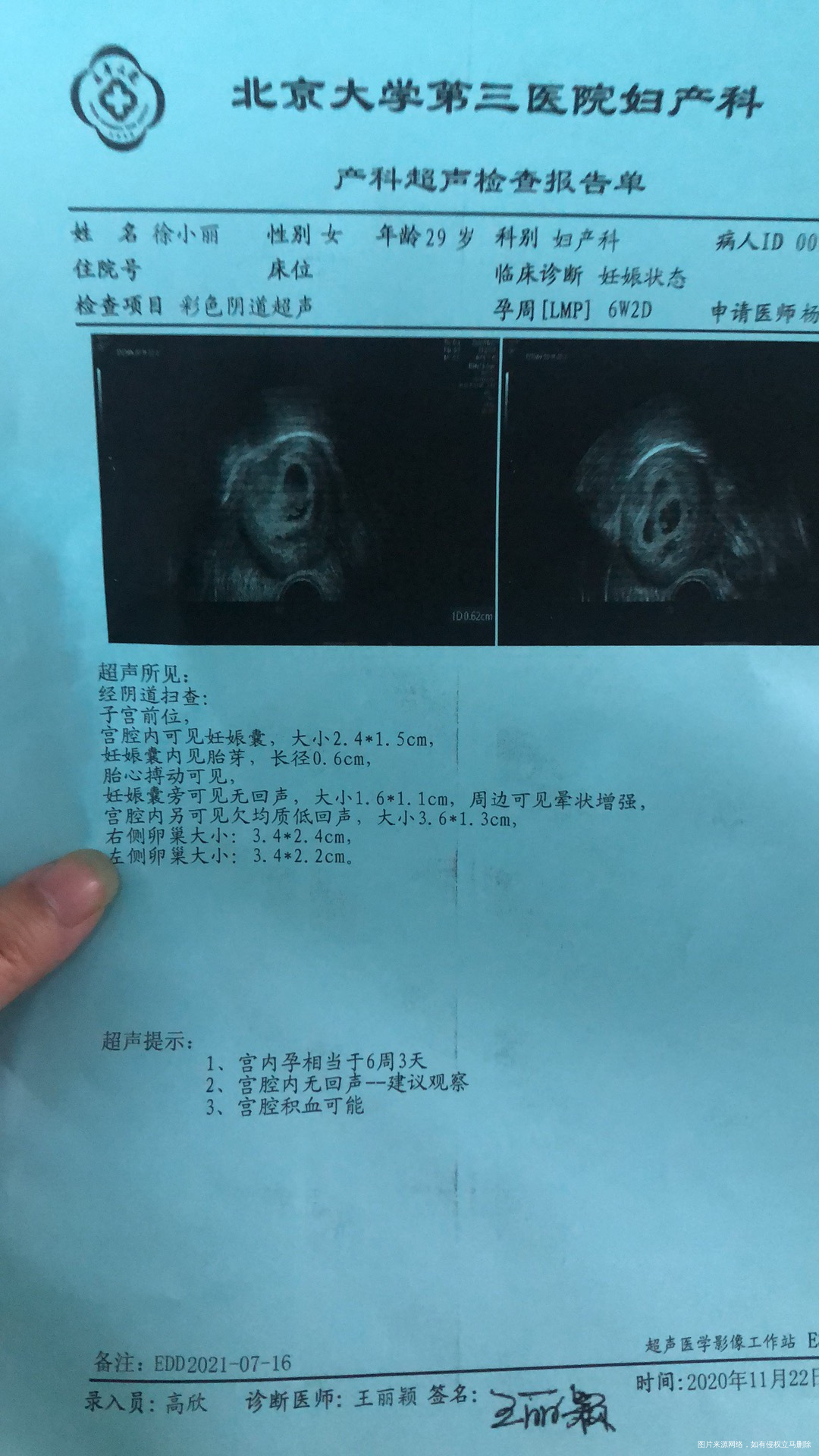 1026移植囊胚一枚移植19天出血就医b超显