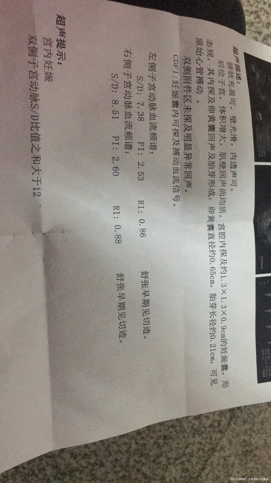 孕50天做的B超这样是不是保胎的希望不大呀医