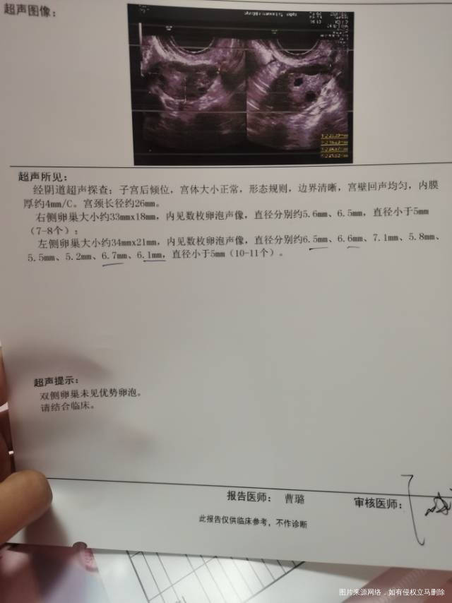 多囊卵巢试管月经第三天雌二醇3405FSH5