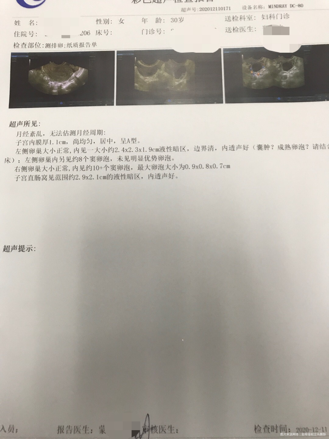 多囊卵巢泌乳素稍高月经周期4060天不等20