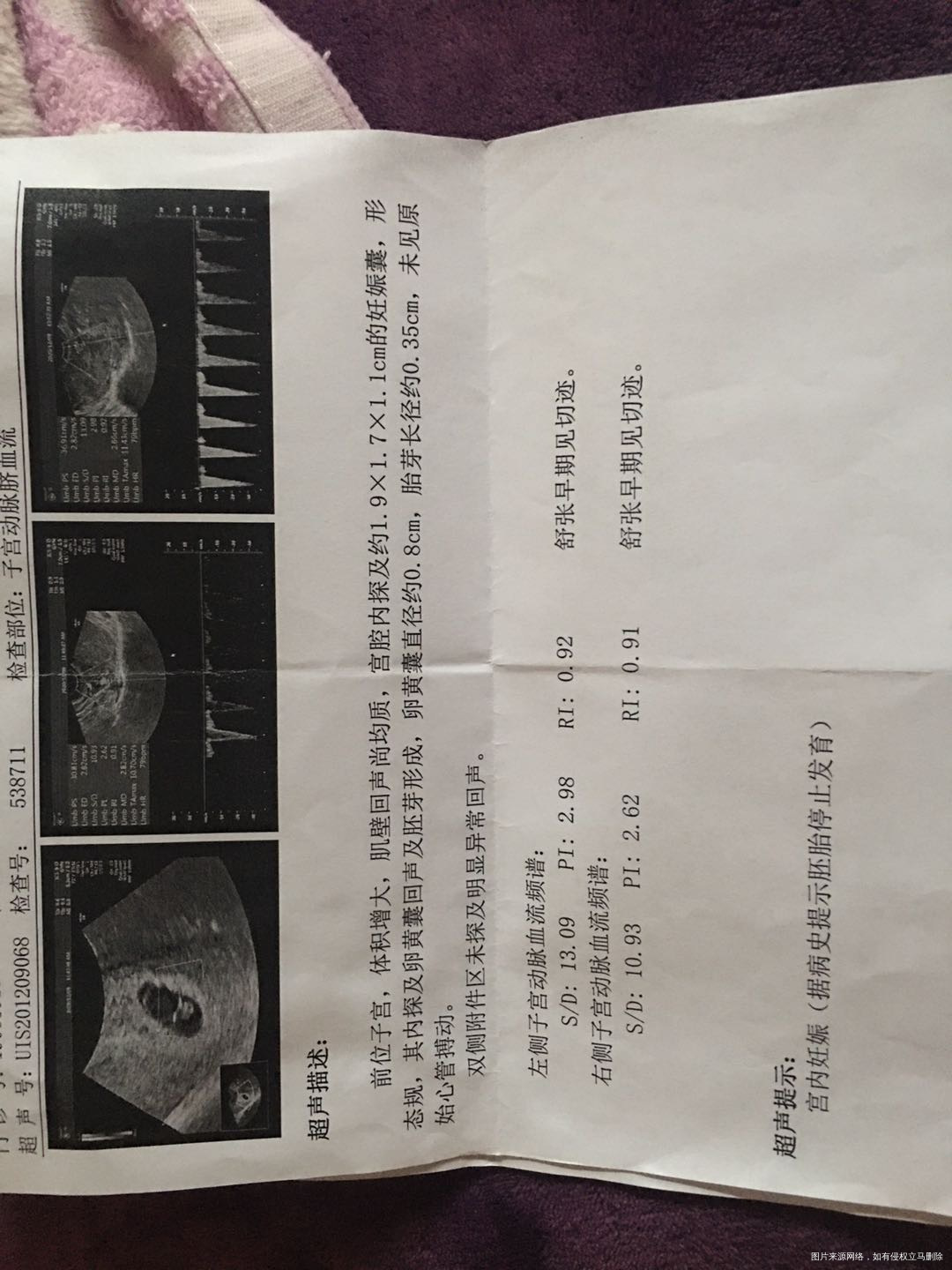 试管第一次移植胎停什么原因导致的卵黄囊8子宫