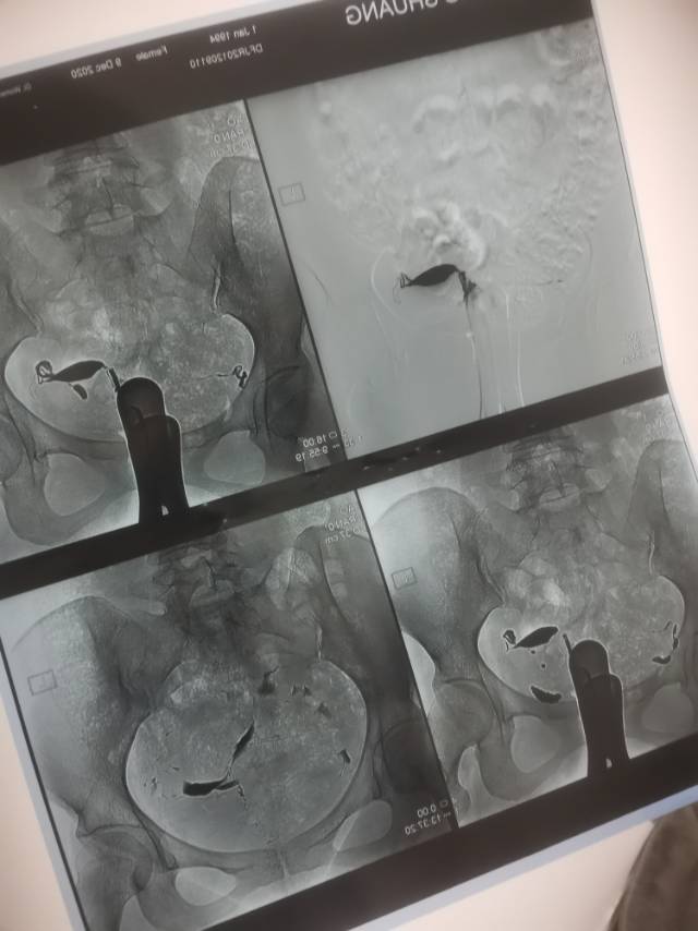 备孕一年多一直没有消息前几天做了输卵管造影显