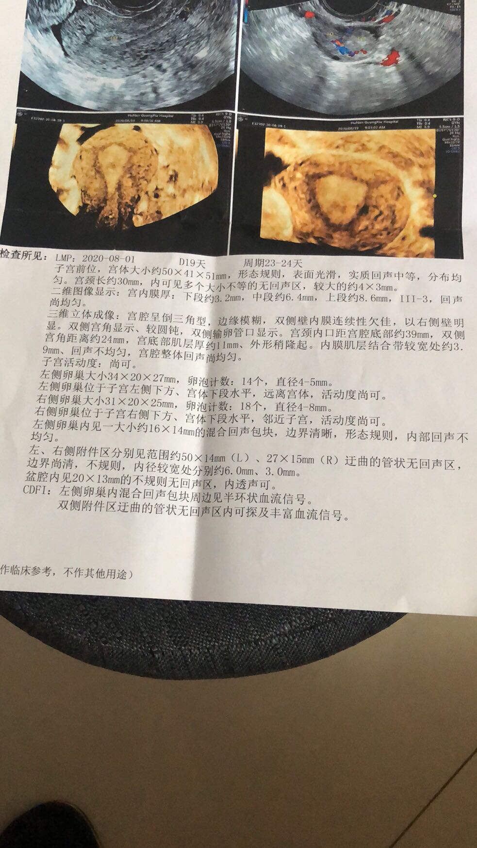 由于流产造成宫腔粘连中度8分2020528进