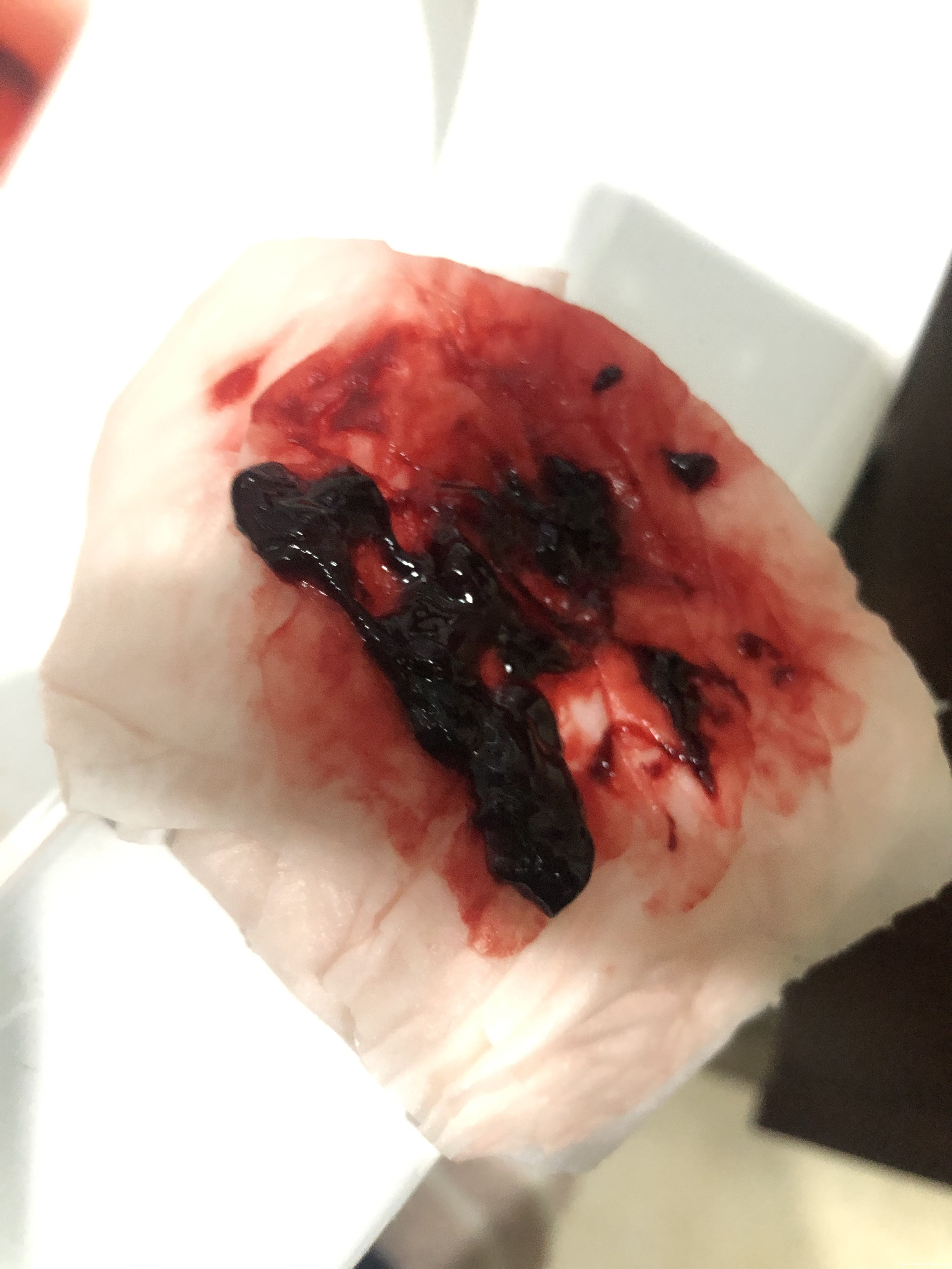 11月25日孕6周超声检查胎心胎芽都正常但是