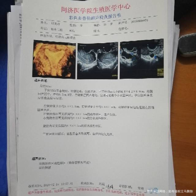 上半年做过造影右边堵塞左边畅而不通卵泡发育不