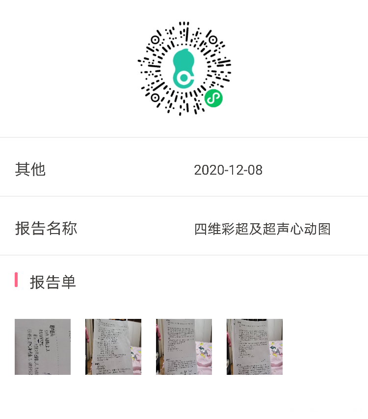 四维彩超显示双胞胎胎儿A肠管回声稍增强肺动脉