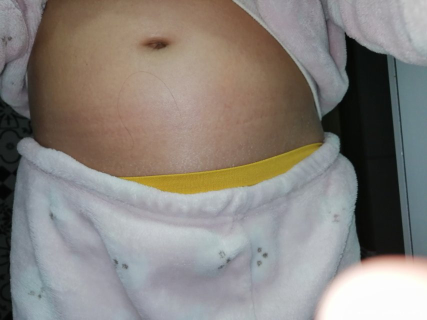 移植第七天了肚脐周围移植很胀感觉肚皮撕拉得很