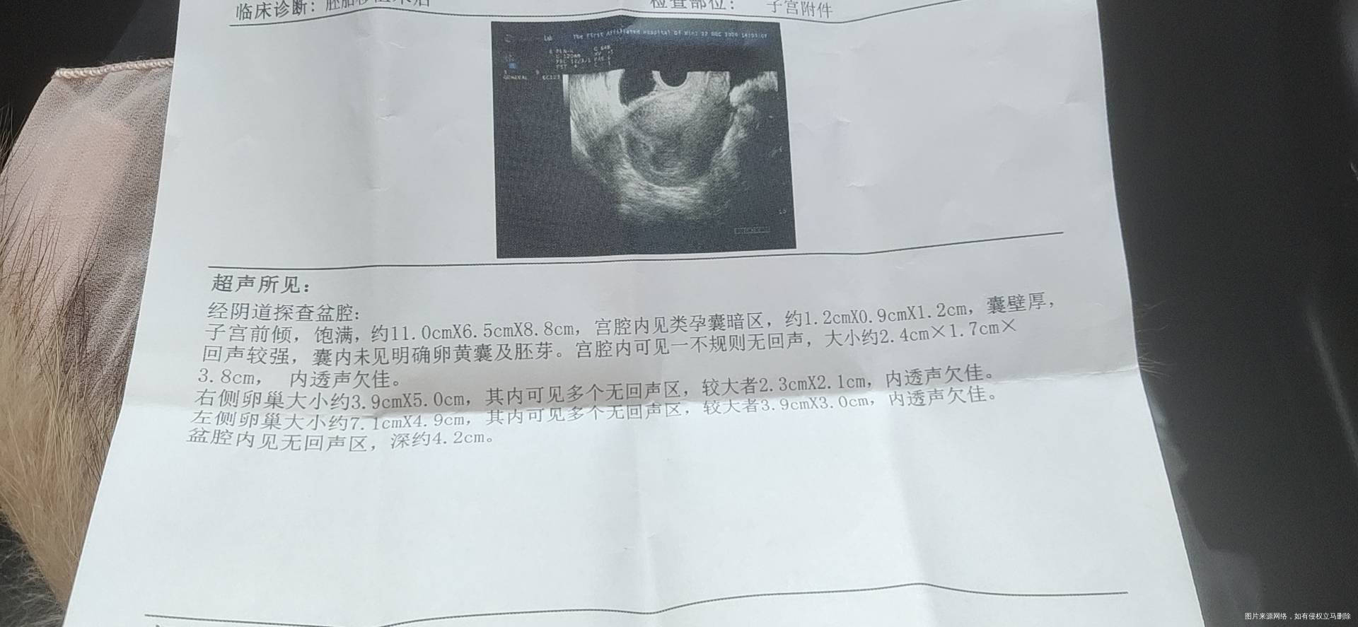 我移植鲜胚第二十七天做b超没有发现卵黄囊也没