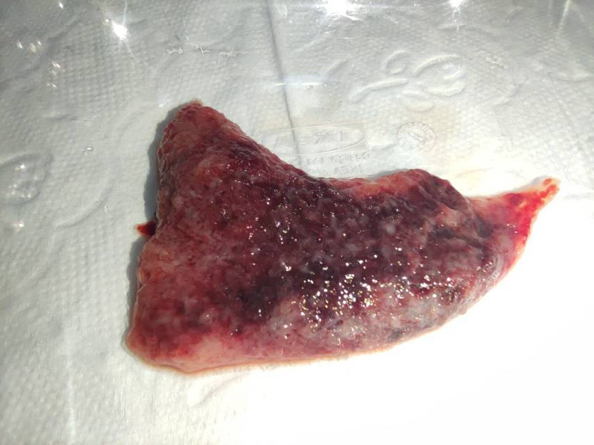 孕8周医生诊断出胎停过了1天自然流产不知道排