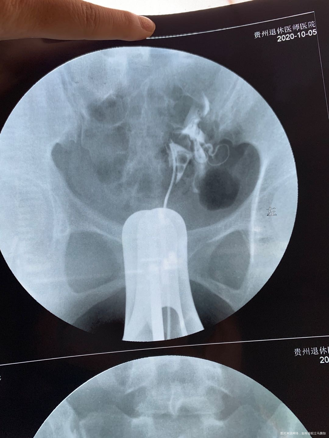 宫外孕手术后3个月做的造影医院那边不建议做腹