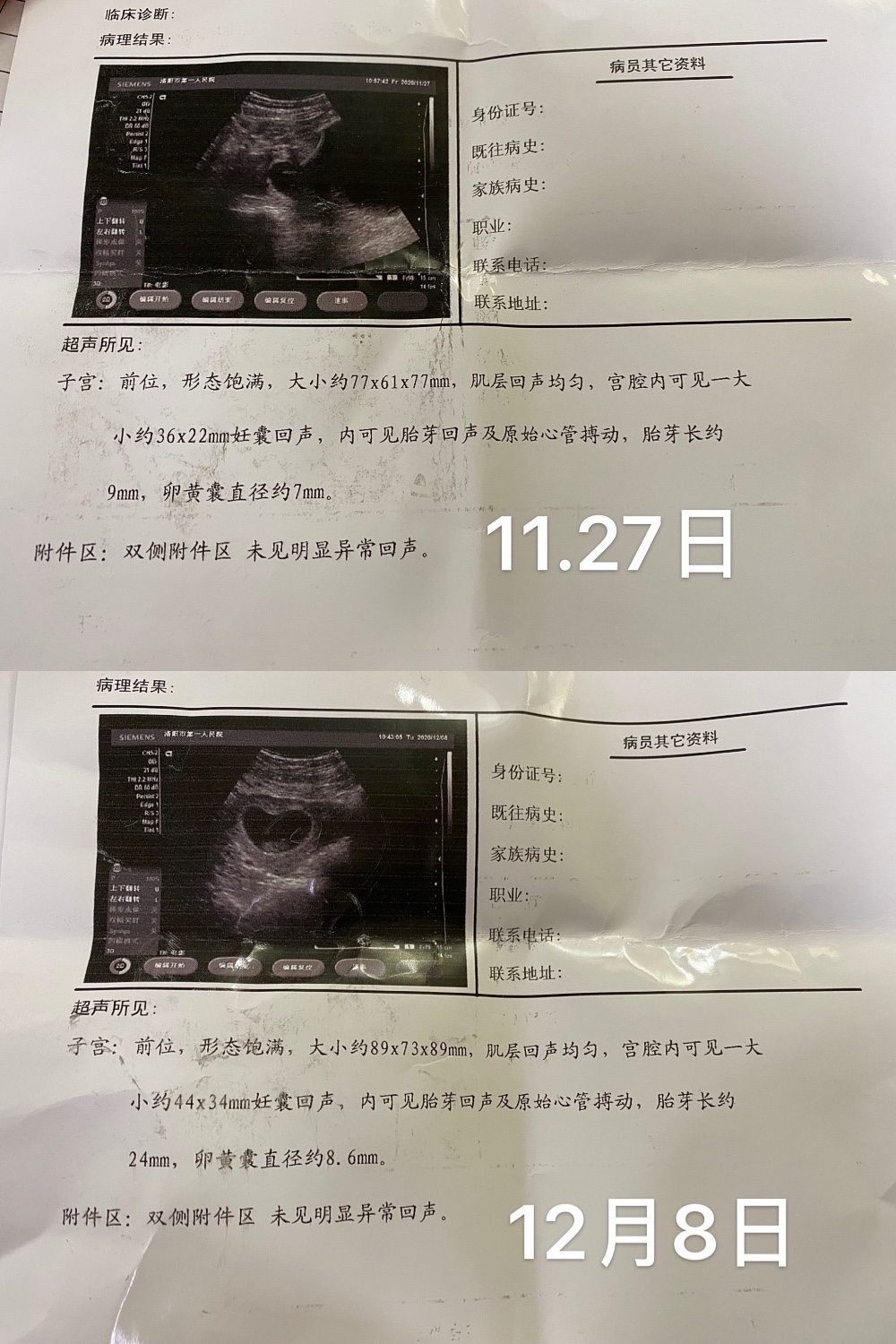 今年四月有胎心后在9周复查胎停育末次月经10