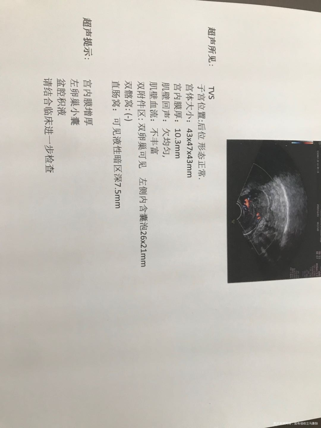 您好我这是多囊卵巢综合征吗