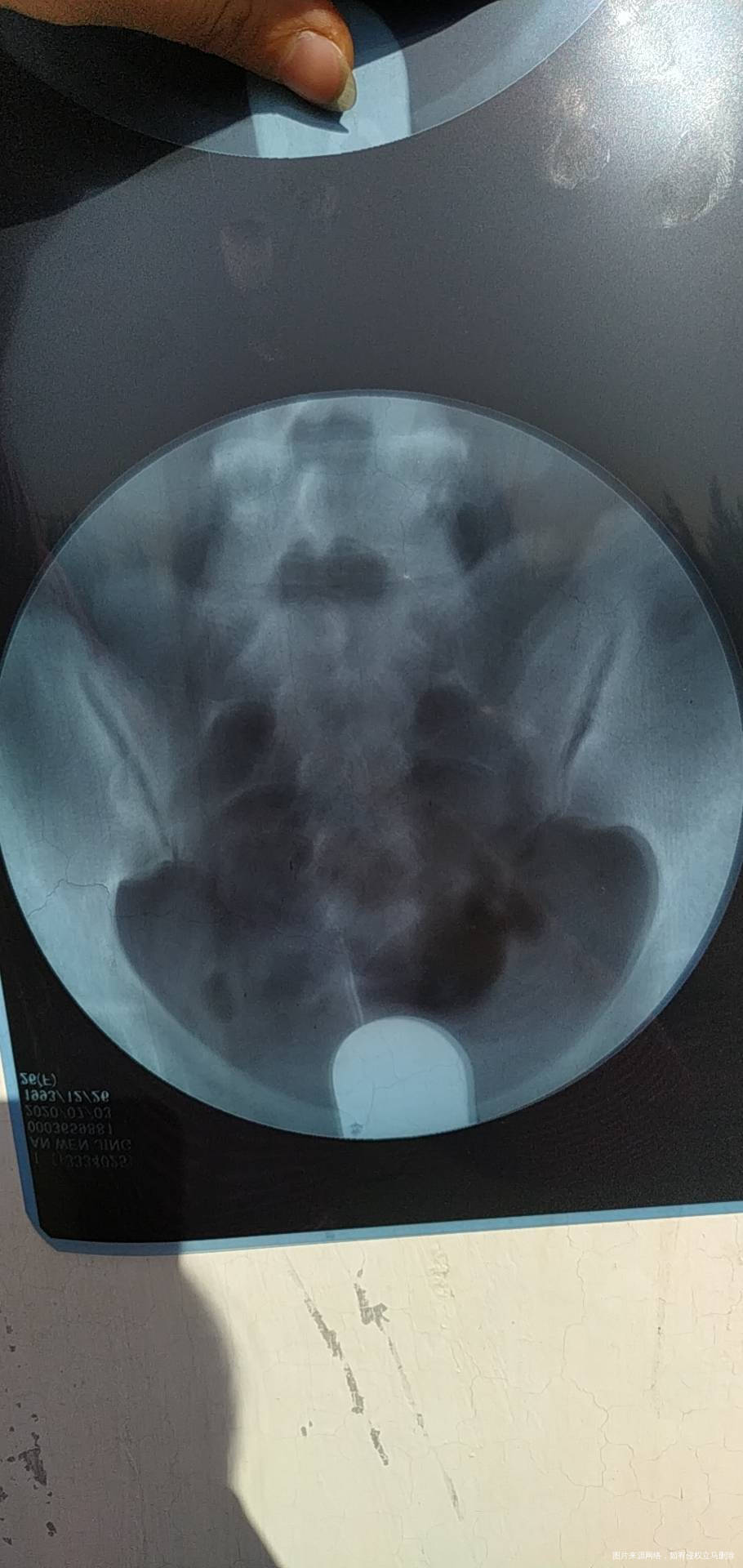 今年七月份做的造影显示输卵管通而不畅伴随多囊