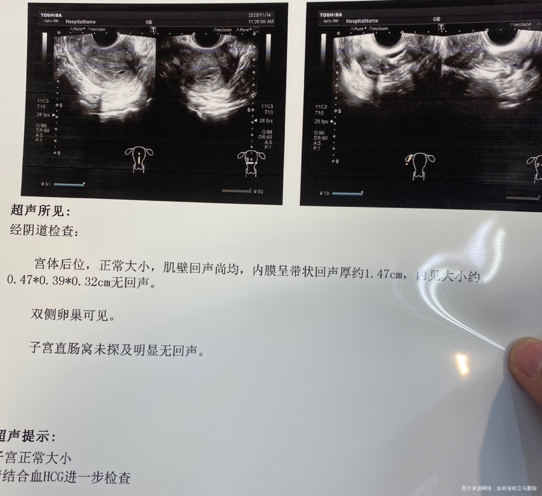 末次104号1115自然流产B超里面是孕囊吗