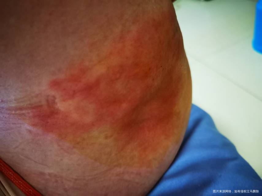 今天是移植后第八天移植后一直在打黄体酮起初只