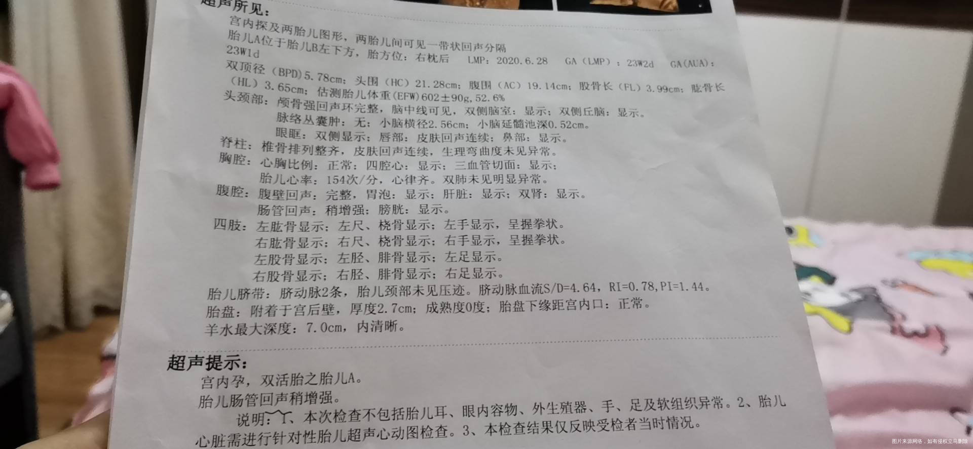 四维彩超显示双胞胎胎儿A肠管回声稍增强肺动脉