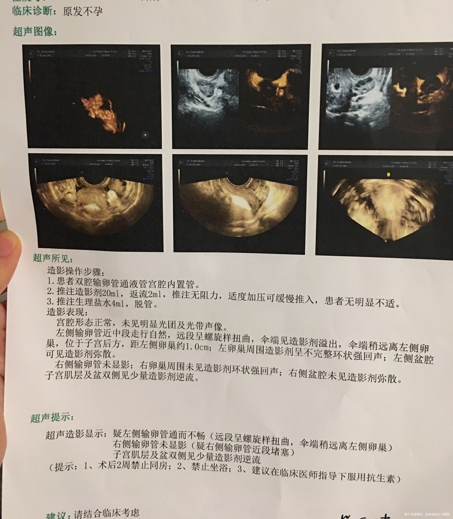 我这个情况能自然受孕吗或者人工授精不想试管