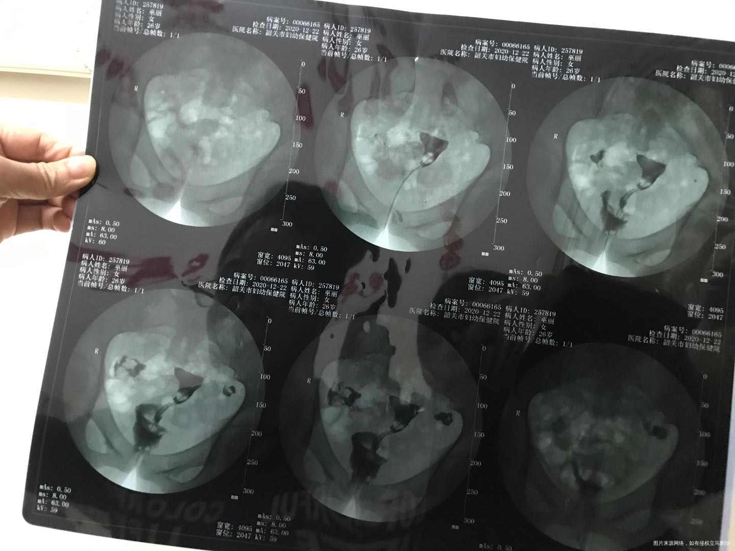 有医生看的懂造影单吗拍的不是很清楚麻烦帮我分