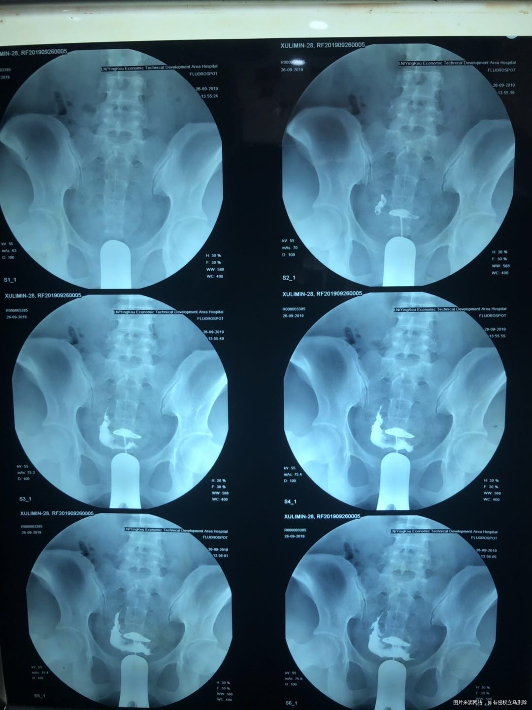 19年做的输卵管造影之后做了几个月监测排卵一