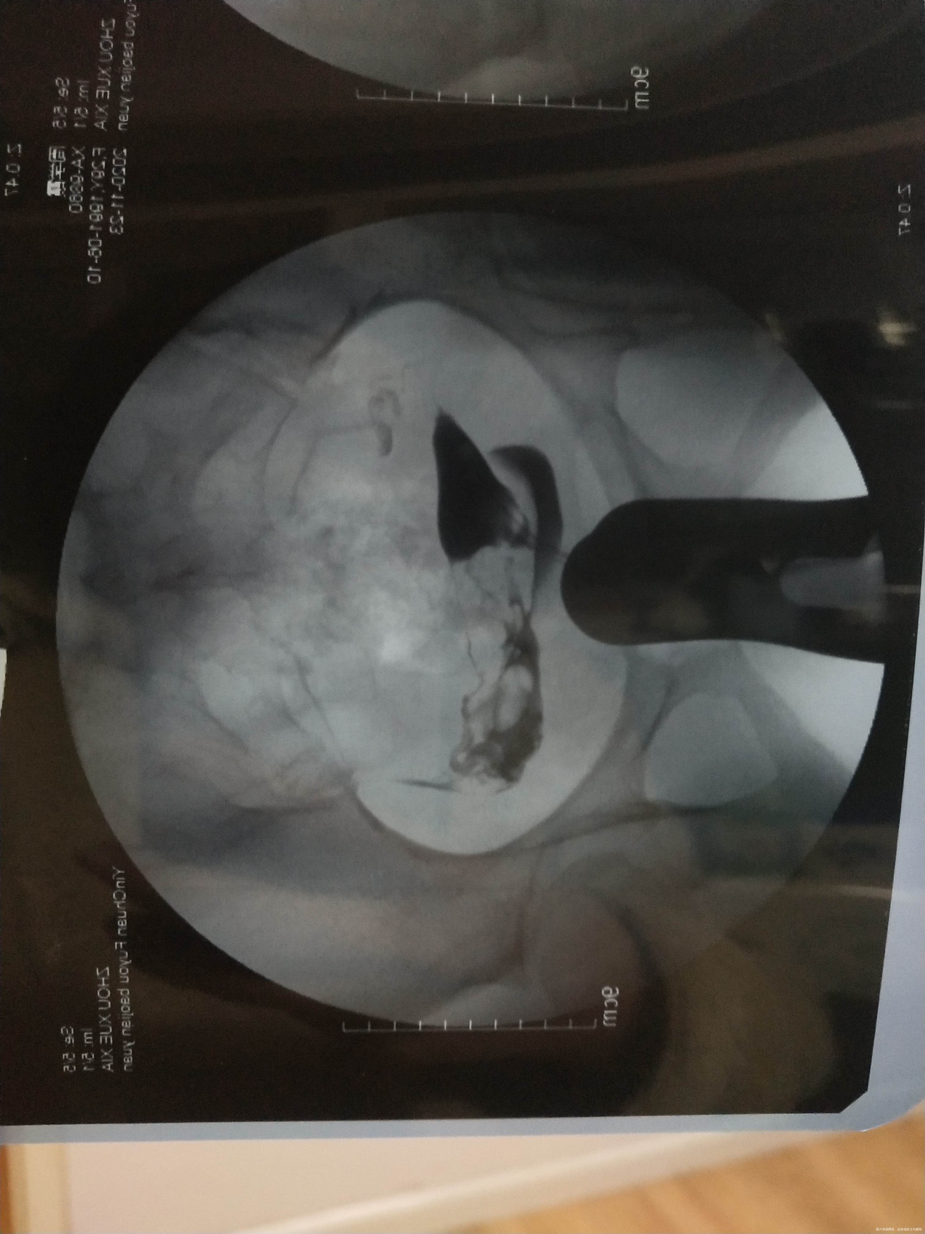 备孕两年之前检测卵泡不破裂有过5年的慢性阑尾