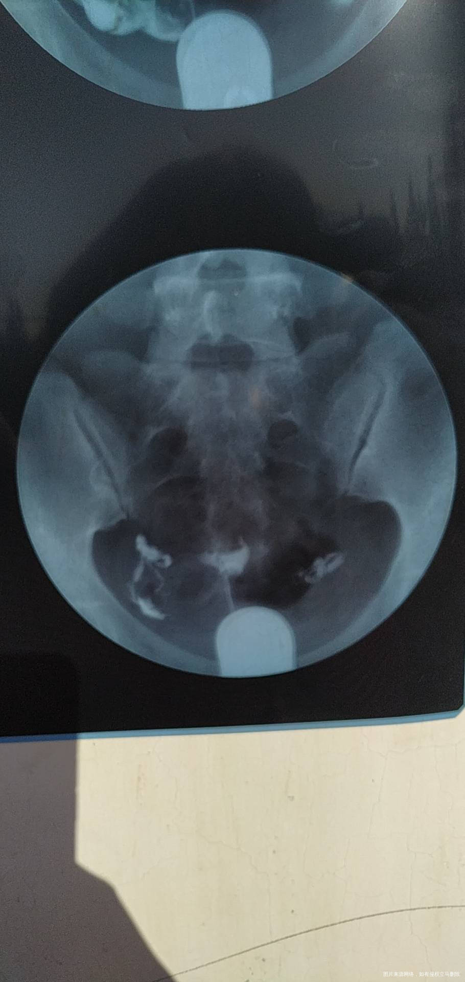 今年七月份做的造影显示输卵管通而不畅伴随多囊