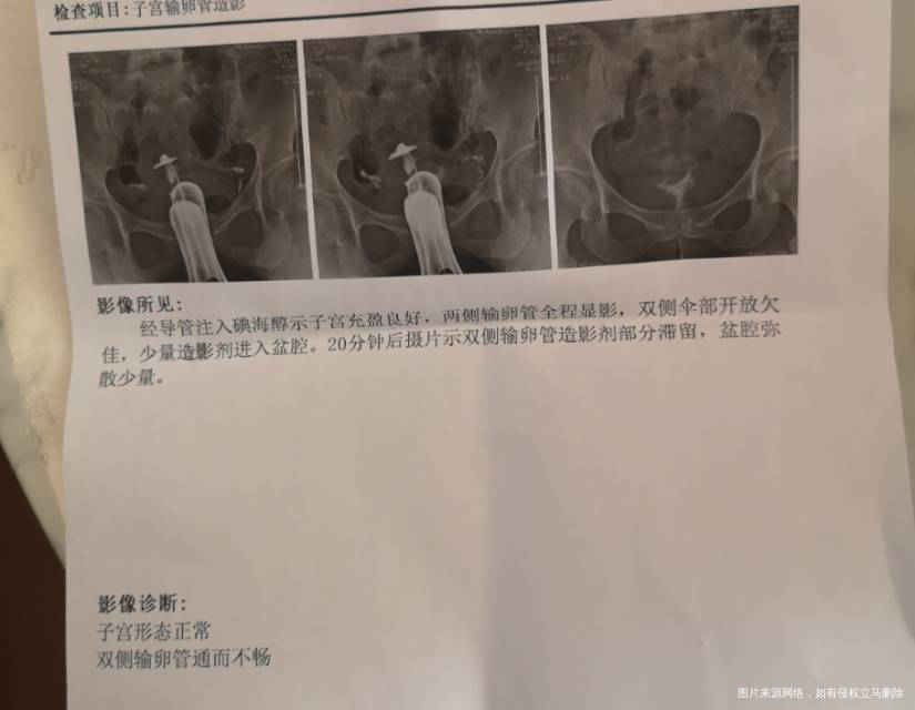 伞端开放不佳是伞部轻微黏连吗这种情况自然怀孕
