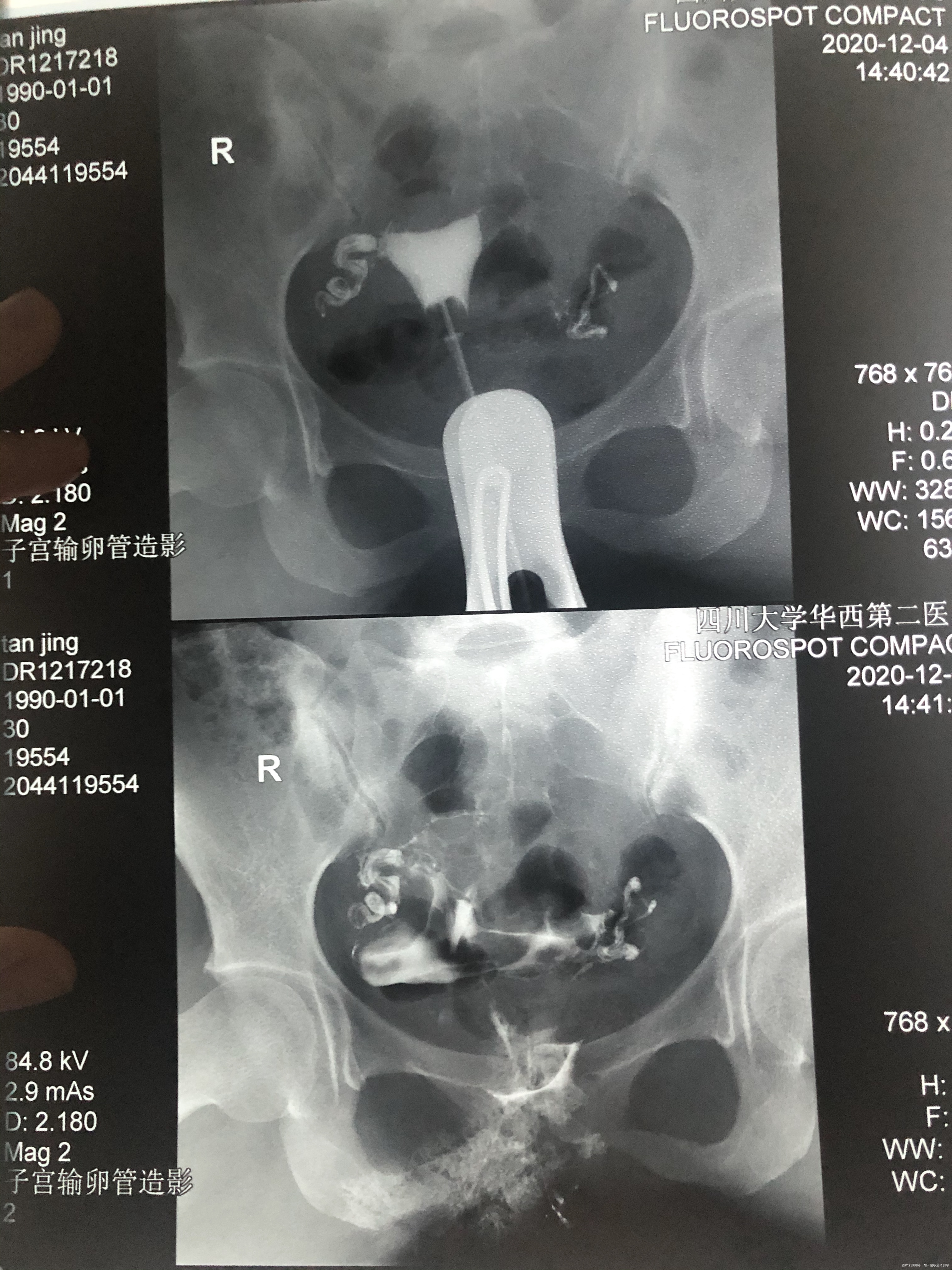 一年多都没怀起前两天做了造影做完拿报告第二天