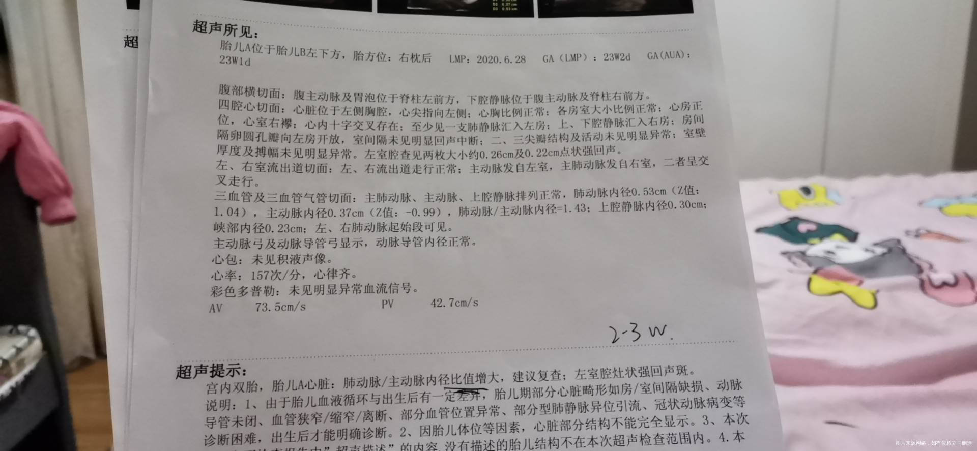 四维彩超显示双胞胎胎儿A肠管回声稍增强肺动脉