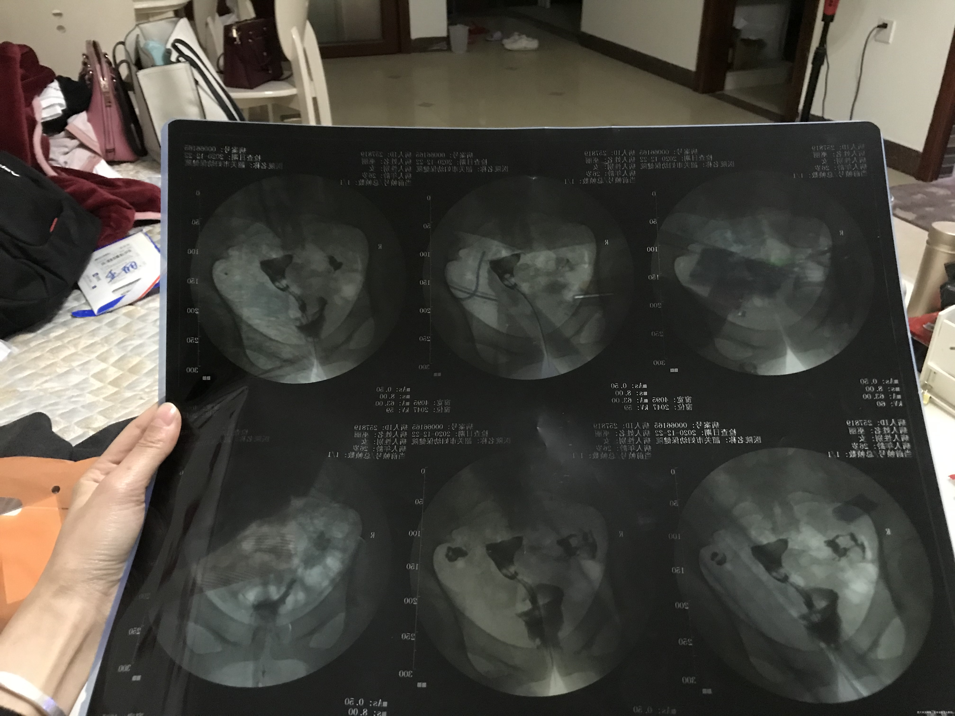 有医生看的懂造影单吗拍的不是很清楚麻烦帮我分