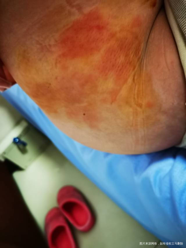 今天是移植后第八天移植后一直在打黄体酮起初只