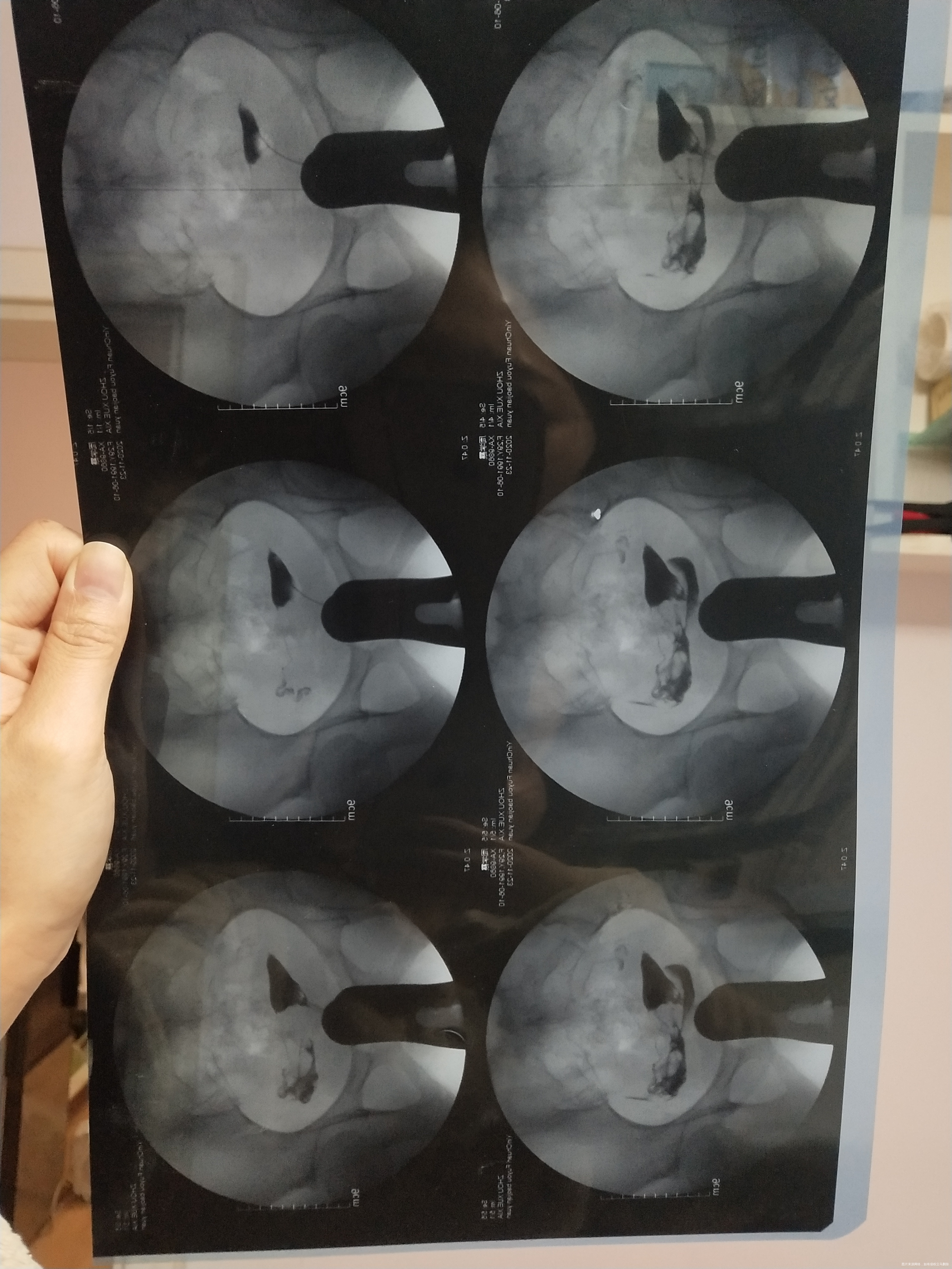 备孕两年之前检测卵泡不破裂有过5年的慢性阑尾