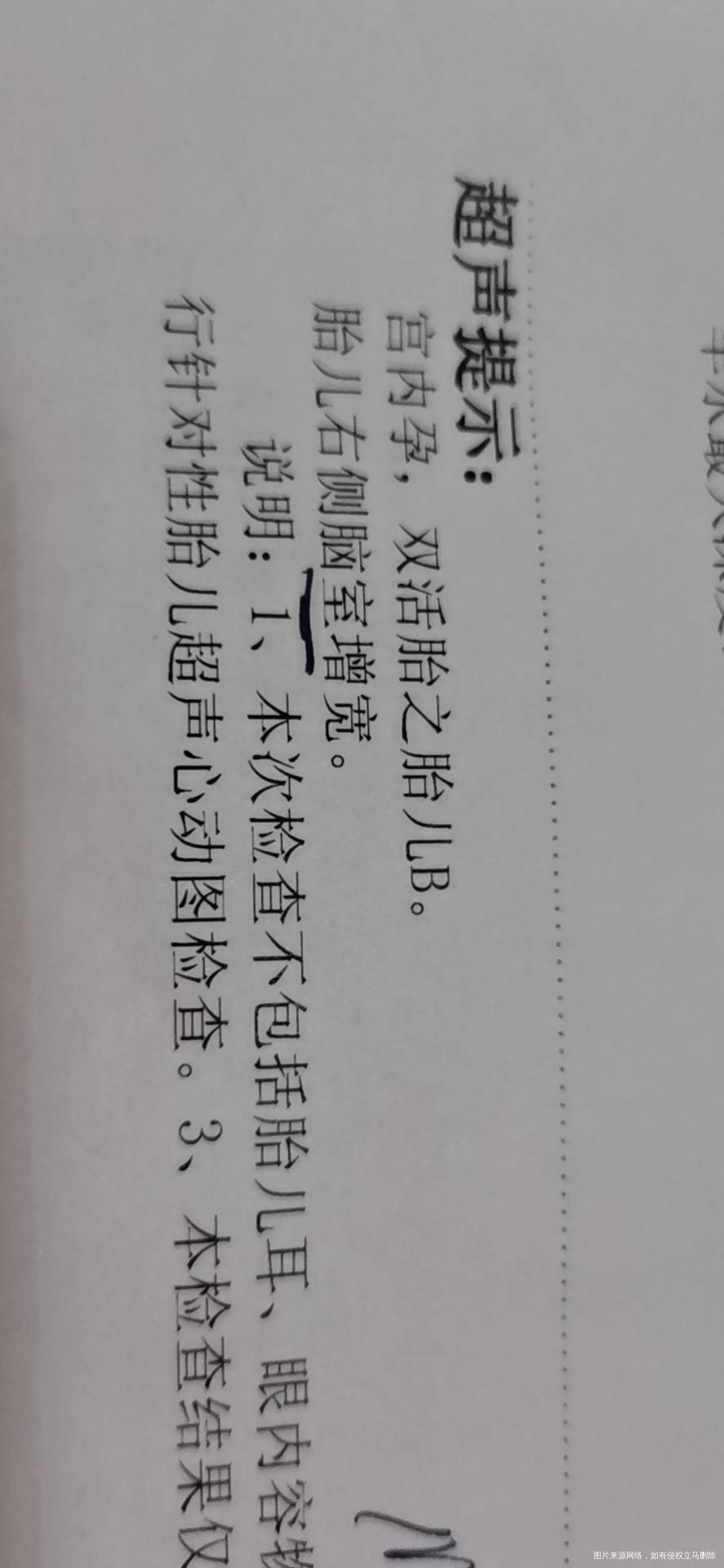 四维彩超显示双胞胎胎儿A肠管回声稍增强肺动脉