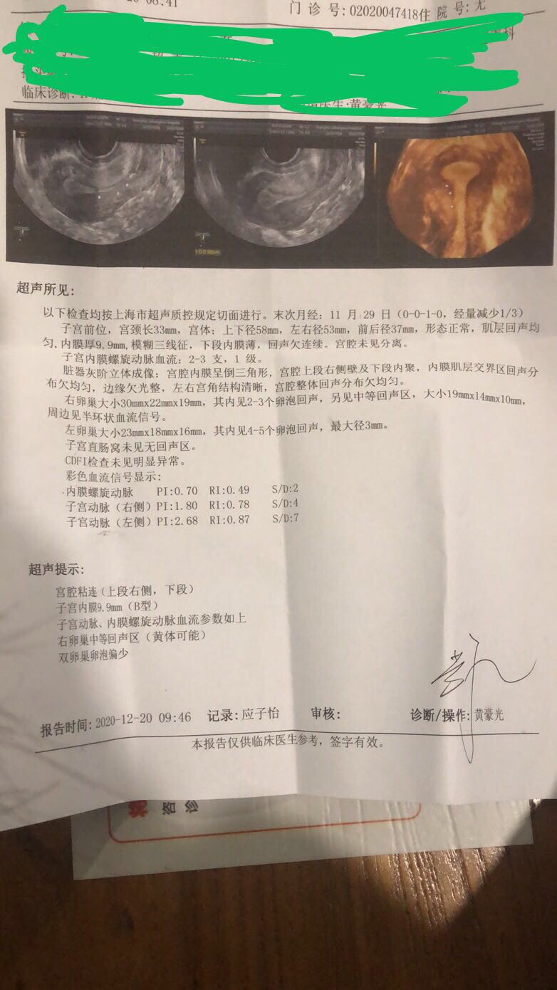 月经量少内膜薄有宫腔粘连双巢卵泡偏少