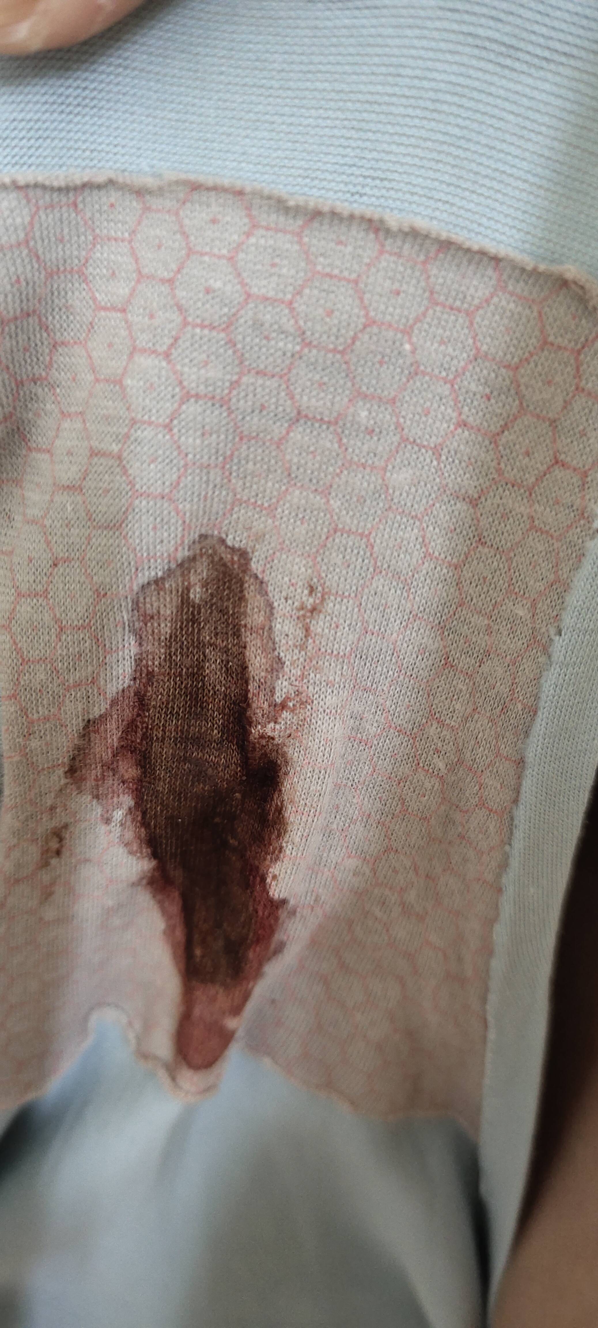 医生你好我今年7月份做了宫腹腔镜手术的手术诊