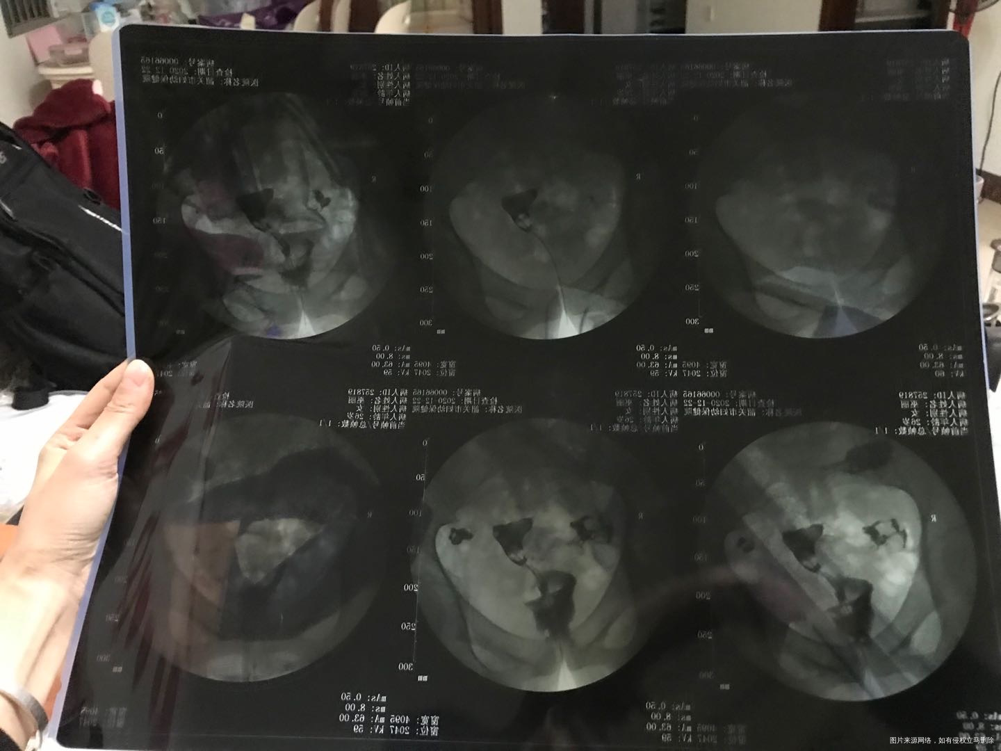 有医生看的懂造影单吗拍的不是很清楚麻烦帮我分