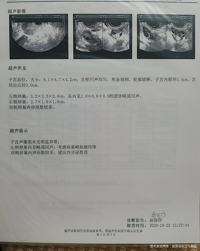 不确定是否排卵是否症状为多囊月经时而提前是否