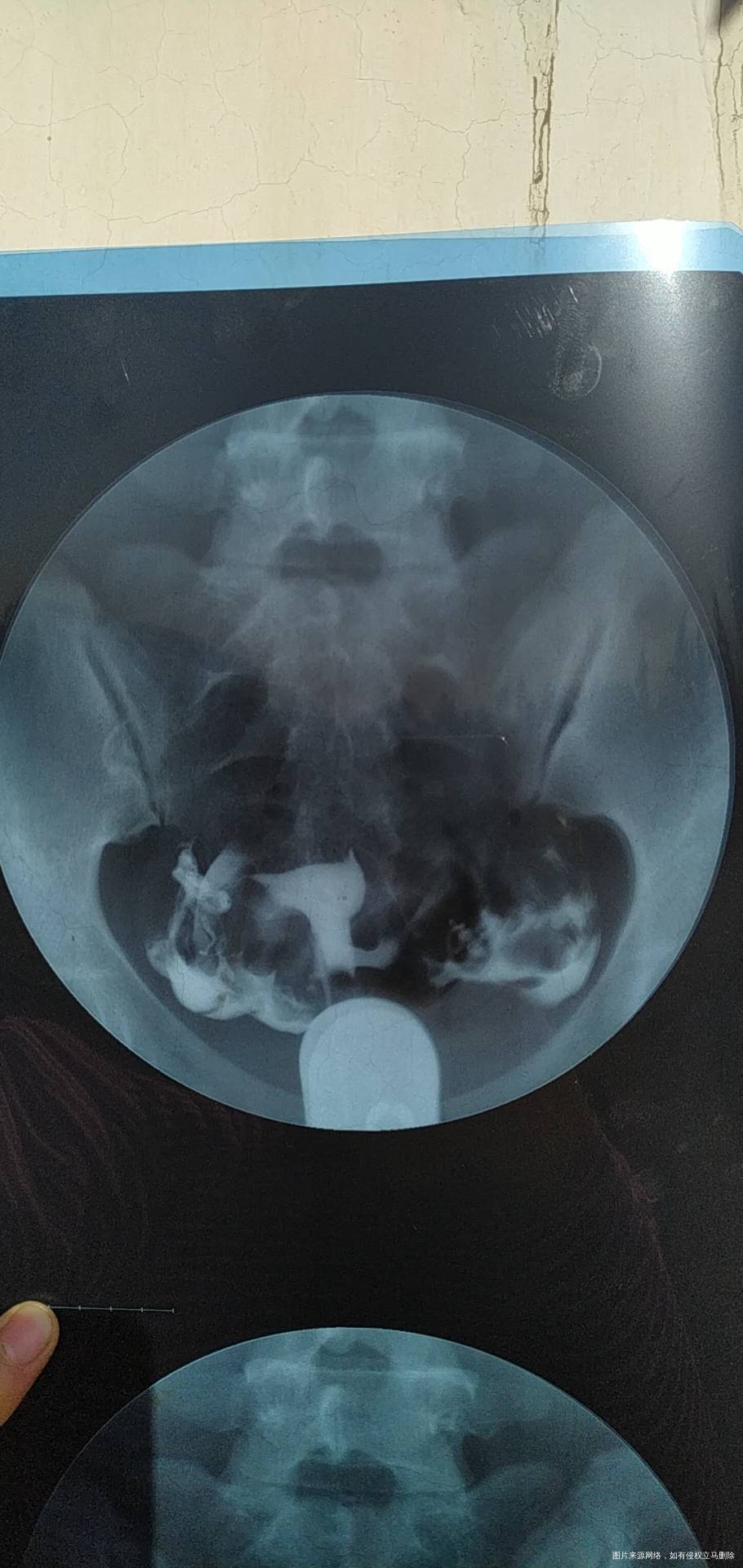 今年七月份做的造影显示输卵管通而不畅伴随多囊