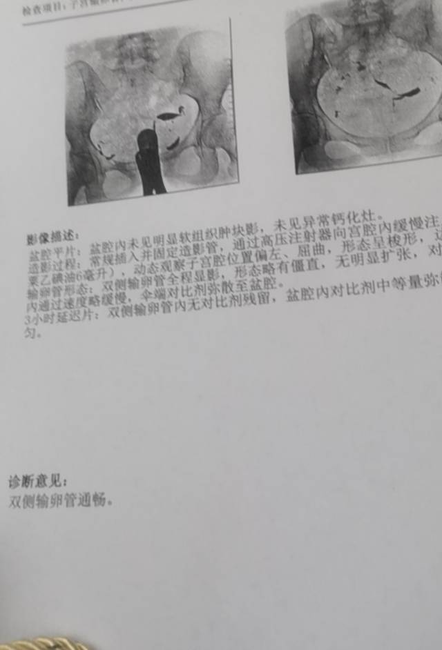 备孕一年多一直没有消息前几天做了输卵管造影显