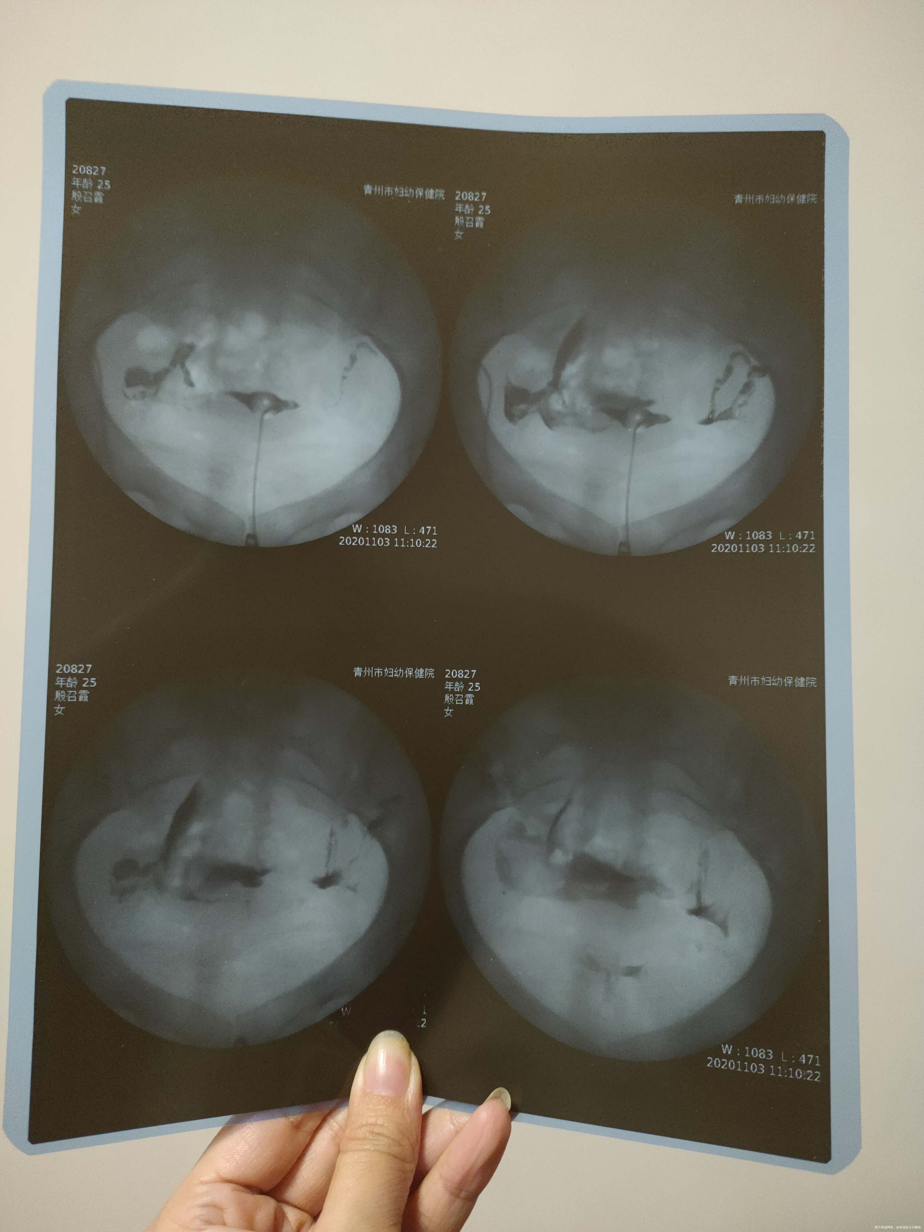 检查性激素六项B超卵泡检测确诊为多囊做过输卵