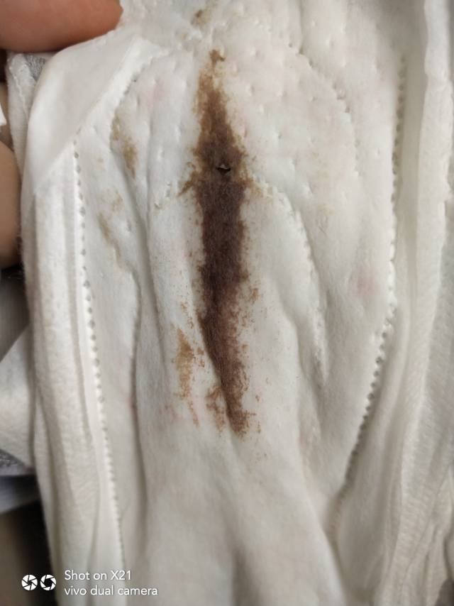 我多囊有四五年了这俩年还有一个子宫肌瘤和一个