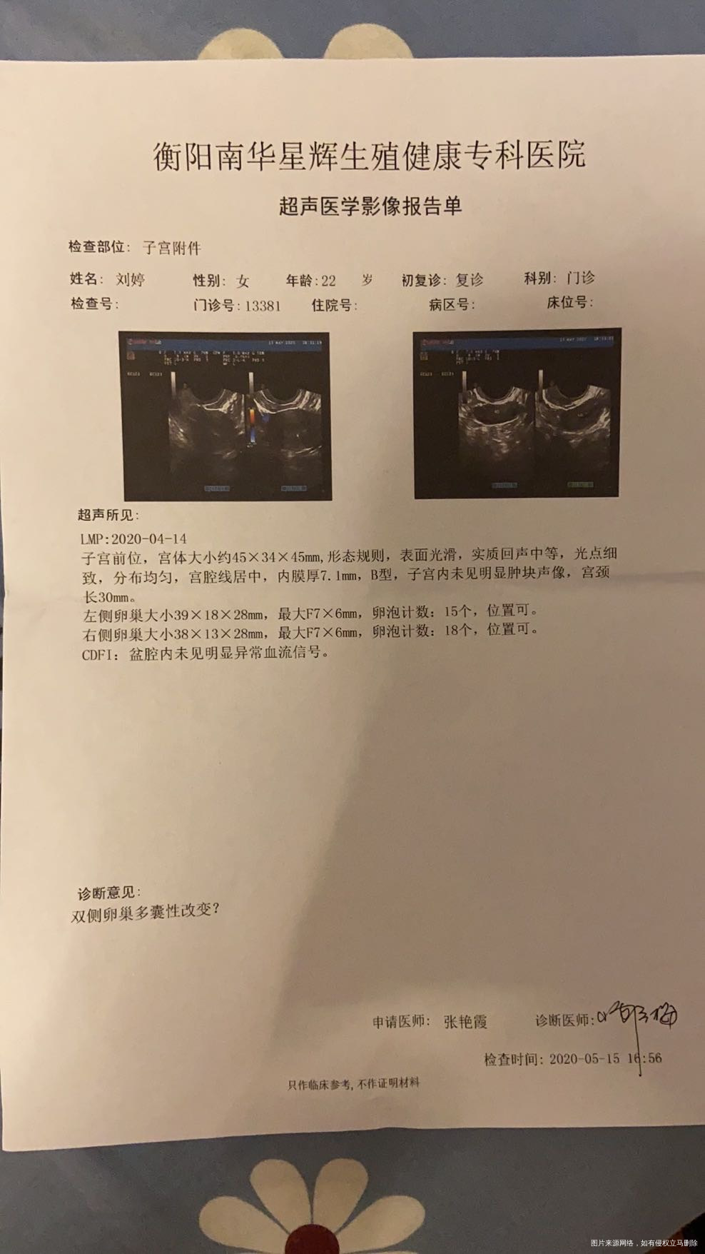 23岁备孕一年左右做过b超查出多囊卵巢综合症